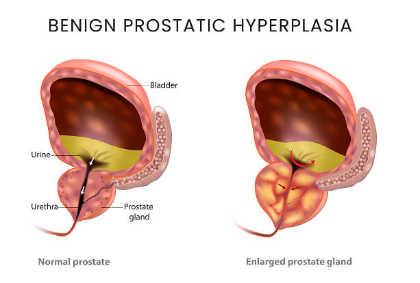 Diagram comparing normal prostate gland to enlarged prostate gland (BPH)